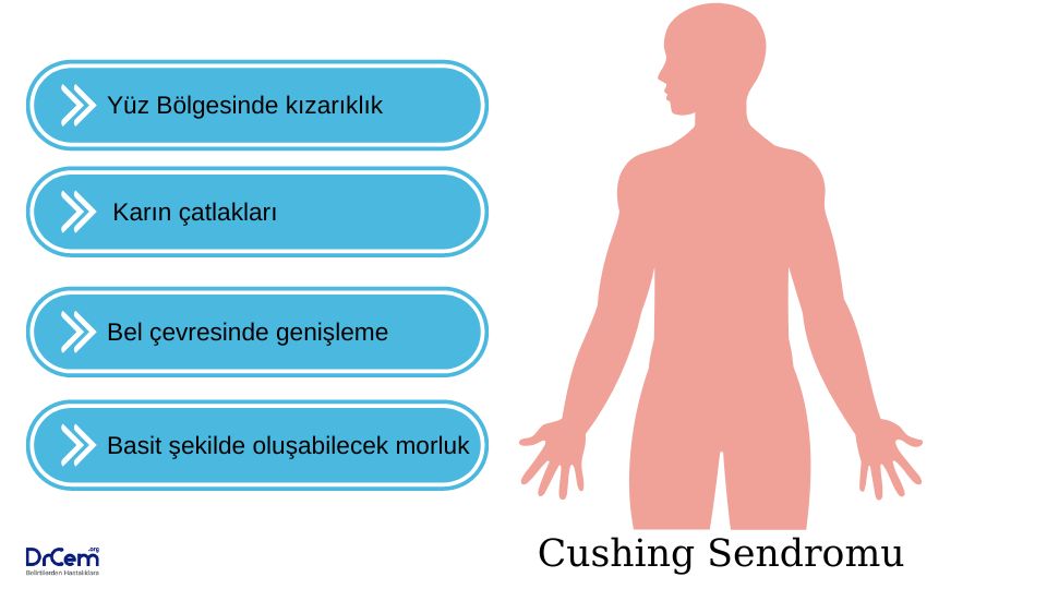 Cushing Sendromu görseli - DrCem hastalık rehberi